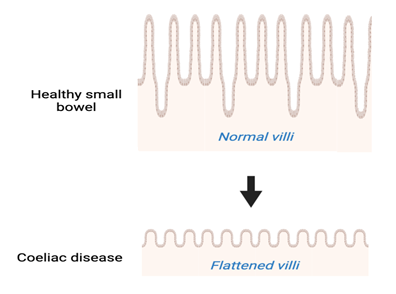 Illustration showing a healthy small bowel with normal villi, and coeliac disease with flattened villi.